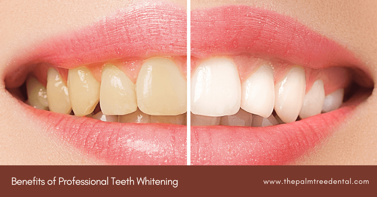 Teeth Whitening Benefits