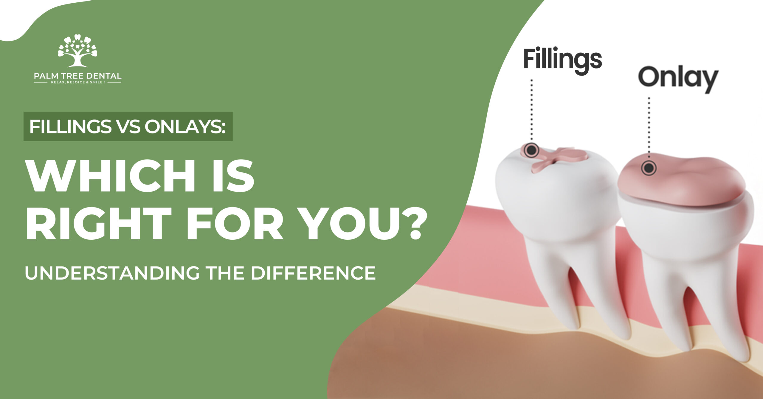 Fillings vs Onlays: Which is Right for You? Understanding the Difference