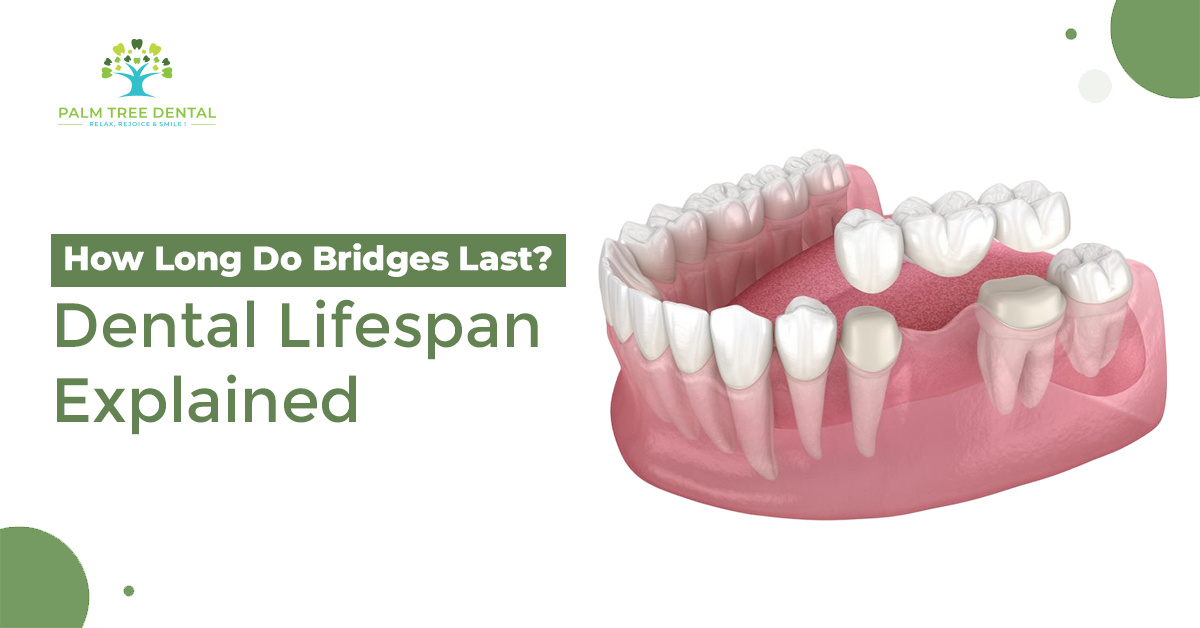 How Long Do Bridges Last? Dental Lifespan Explained