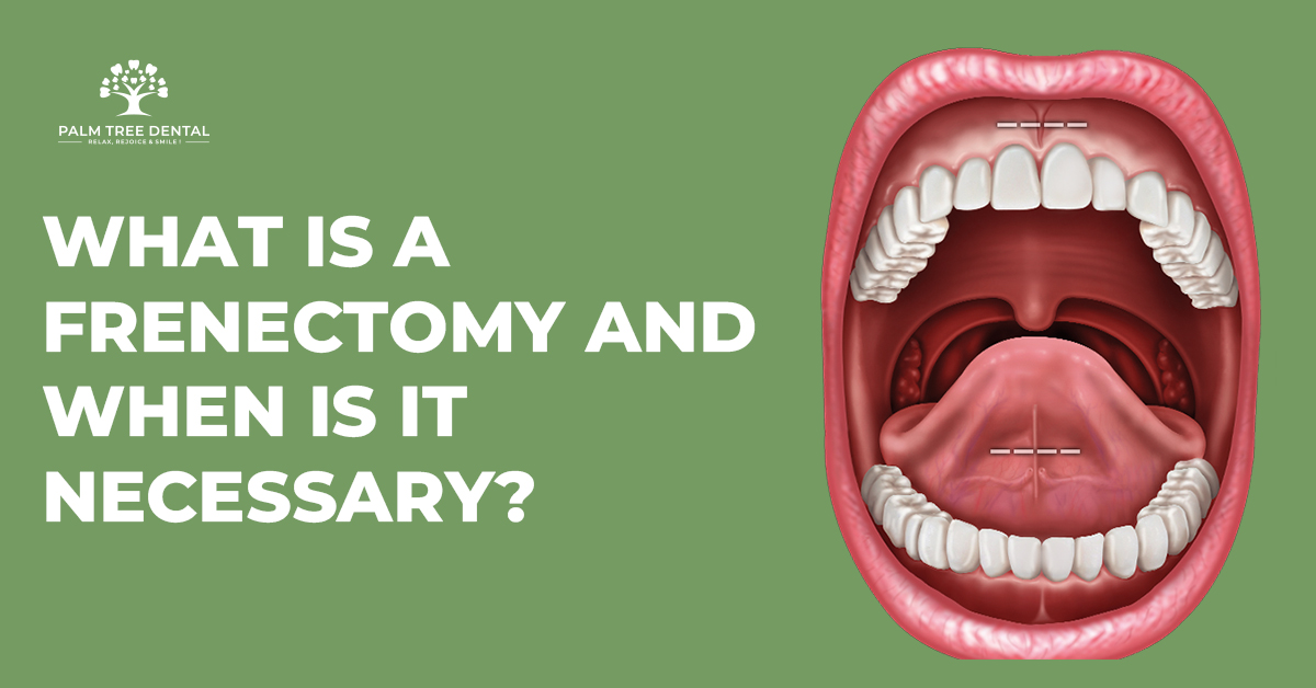 What Is a Frenectomy and When Is It Necessary?