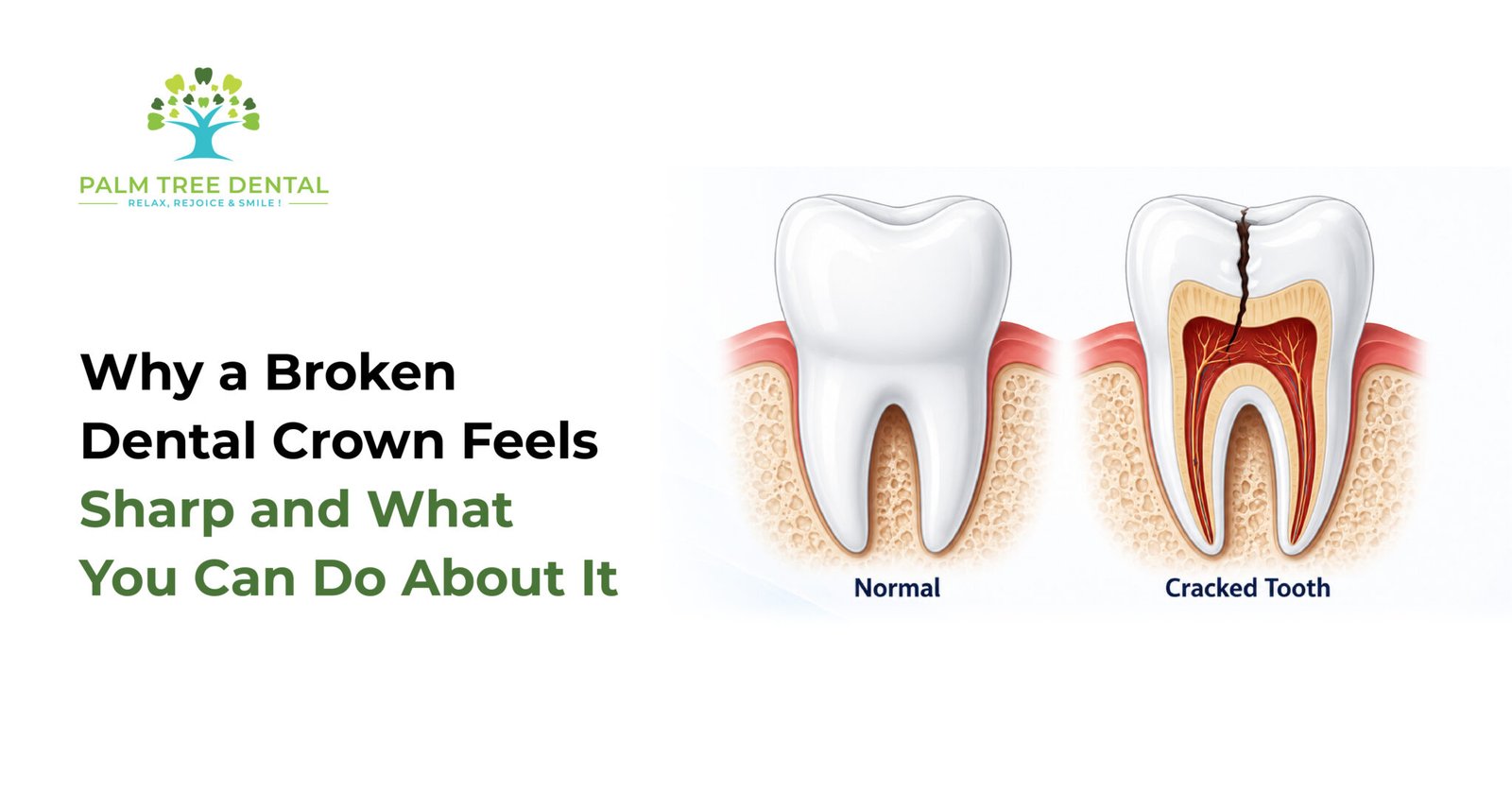 Sharp Crown Why a Broken Dental Crown Feels Sharp and What You Can Do About It